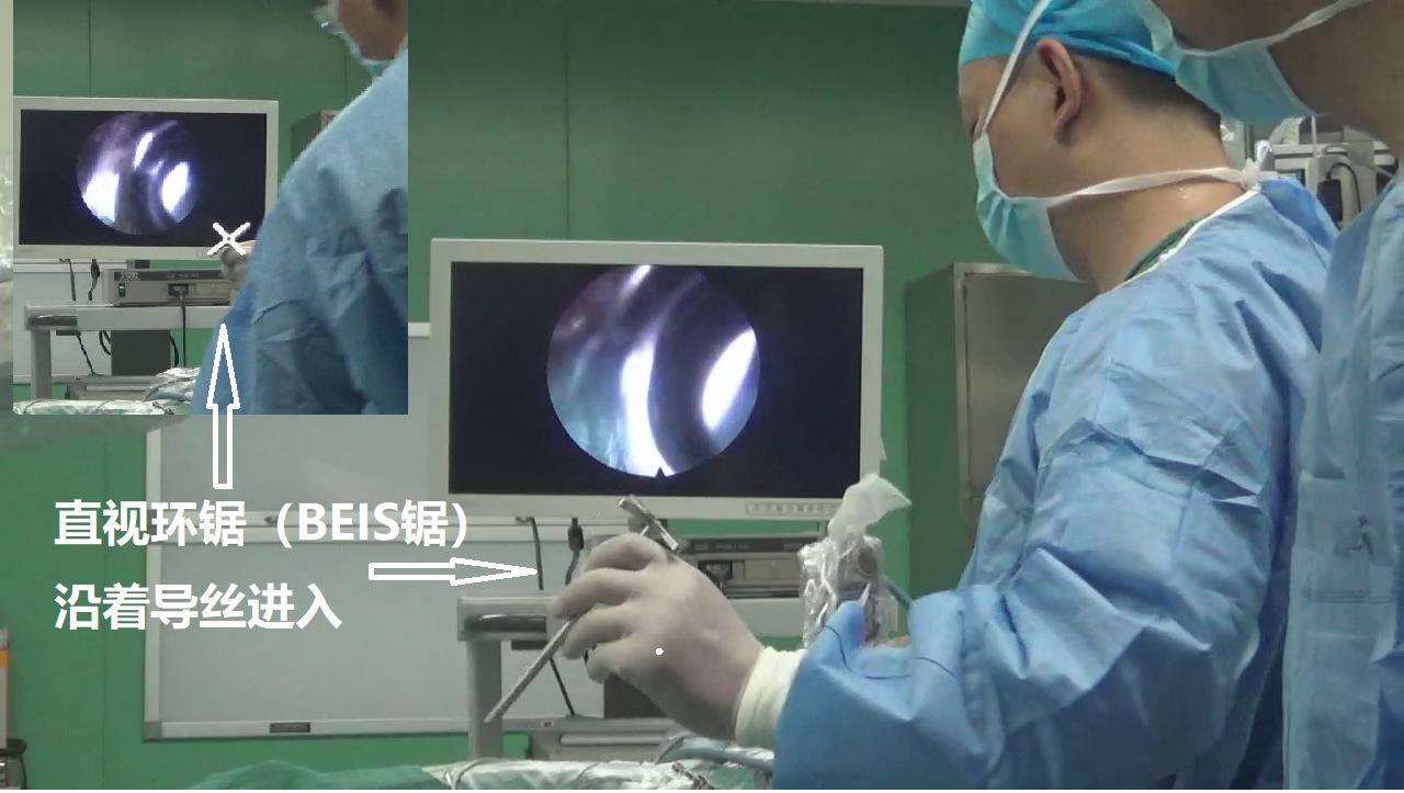 15-直视环锯（BEIS锯）沿着导丝进入.jpg